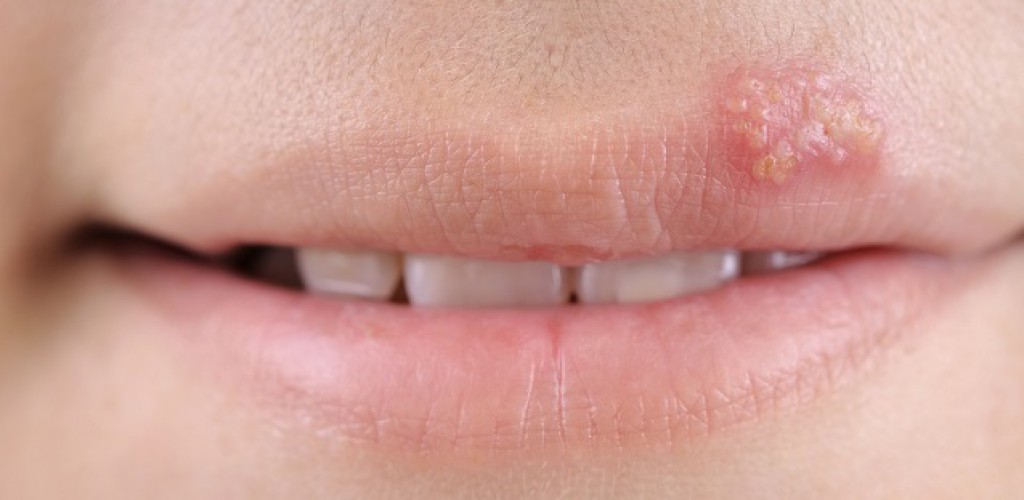 SOS: schnelle Hilfe bei Lippenherpes
