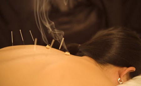 Traditionelle chinesische Medizin: Akupunktur